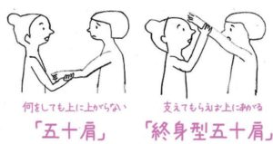 五十肩と終身型五十肩の違い