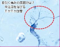 モヤモヤ血管